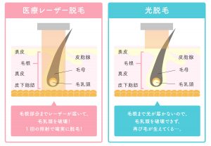 医療脱毛は痛い 口コミと対策から見る 痛くない 理由 医療脱毛ならremvy 医療脱毛は痛い 口コミと対策から見る 痛くない 理由 医療脱毛ならremvy