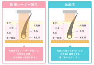 医療脱毛は痛い 口コミと対策から見る 痛くない 理由 医療脱毛ならremvy