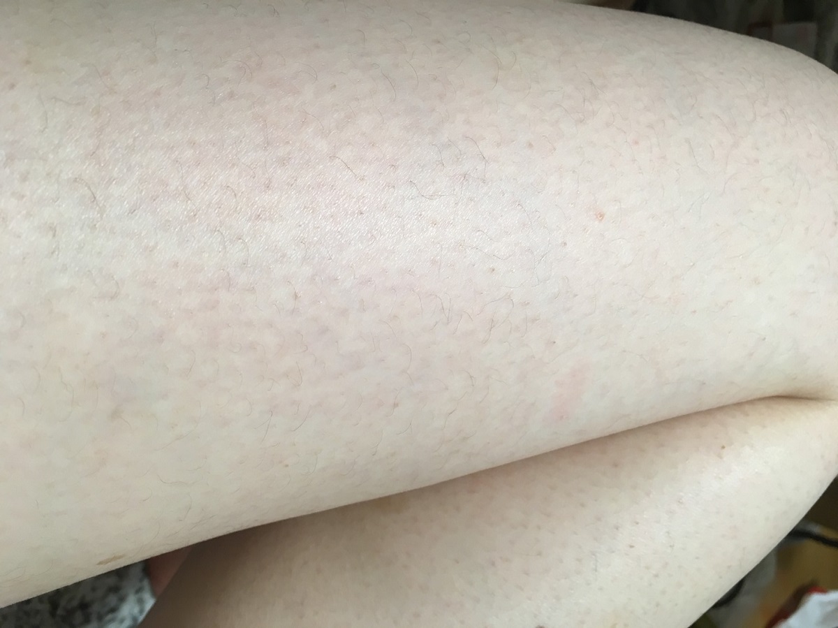 体験レポ R子 レジクリ全身脱毛1回目を本音でレポ 医療脱毛ならremvy