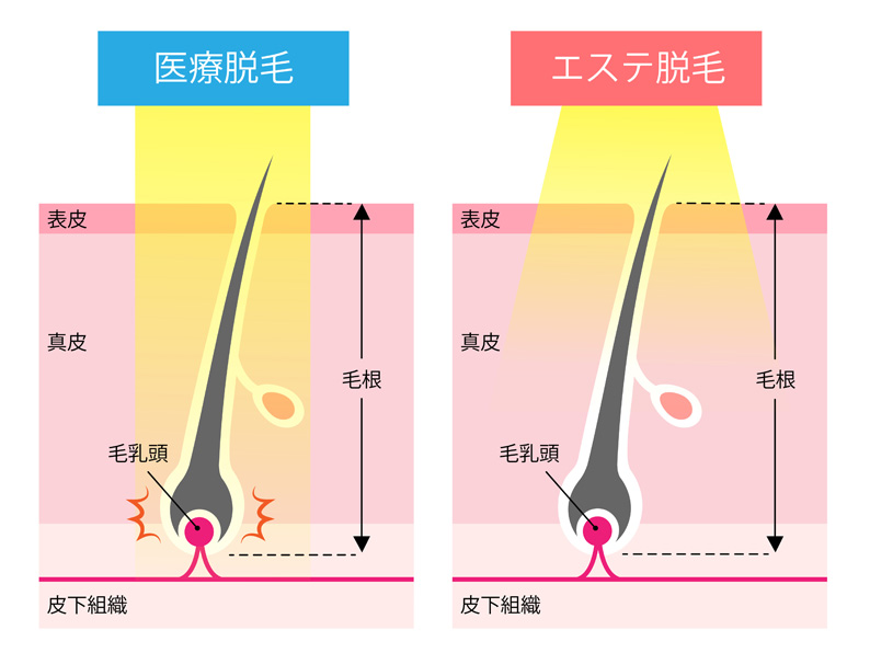 医療脱毛とエステ脱毛の違い